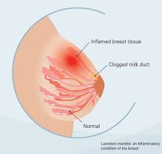 Ask your pharmacist how to do this correctly. Mastitis Causes Prevention And Treatment Medcaretips Com