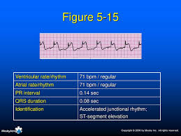 An accelerated junctional rhythm (rate >60) is a narrow complex rhythm that often supersedes a clinically bradycardic sinus node rate (see images below). Practice Rhythms Strips Ppt Download