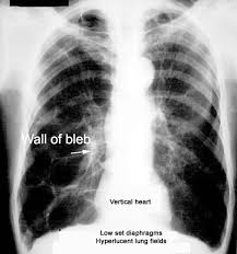 Image result for Emphysema