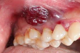 This is the second time this has happened. Bump On Gums Causes And How To Treat Them
