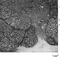 Image result for Expressed Prostatic Secretion