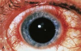 Image result for Ciliary Flush