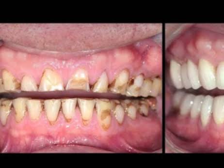 Full Mouth Rehabilitation of teeth in Nagpur product image