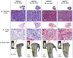 When you're diagnosed with breast cancer, your doctor will give your cancer a grade from 1 to 3 based on how much your cancer cells resemble normal cells. Development Of Clinically Relevant In Vivo Metastasis Models Using Human Bone Discs And Breast Cancer Patient Derived Xenografts Breast Cancer Research Full Text