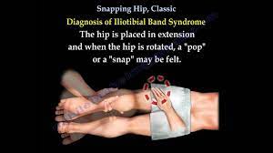 Snapping Hip Classic Everything You Need To Know Dr Nabil Ebraheim Youtube