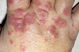 Image result for Erythema Multiforme
