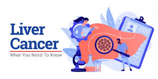 The symptoms are the same if the liver cancer starts in the liver (primary liver cancer) or spreads from another part of the body (secondary liver cancer). Liver Cancer What You Need To Know News Makati Medical Center