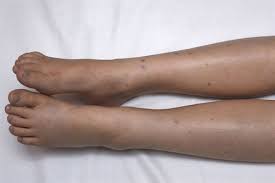 In another form, known as henoch's purpura, affected individuals have purplish spots on the skin and acute abdominal problems, such as glomerulonephritis (a type of kidney disorder). Henoch Schonlein Purpura