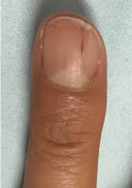 Is this black spot under my toenail cancer? Evaluation Of Nail Lines Color And Shape Hold Clues Cleveland Clinic Journal Of Medicine