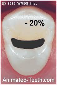 As previously mentioned, tooth enamel cannot. Dental Crown Vs Big Filling Factors To Consider When Choosing
