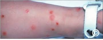 Image result for Papular urticaria
