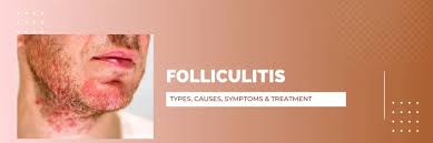 Image result for folliculitis symptoms
