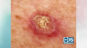 Of course, your specialist is the main person whose advice you should follow but it doesn't do anyone harm. Skin Cancer Detection Prevention