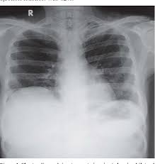 Loss of the costophrenic angle. Figure 1 From Bilateral Pleural Effusion A Rare Case Report Semantic Scholar