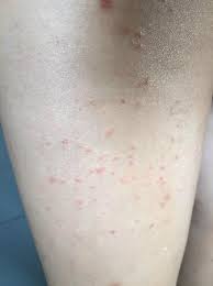 Check spelling or type a new query. Friend 2 Bitten By Dust Mites Left Thigh Picture Of Kim Samnang Guesthouse Phnom Penh Tripadvisor