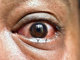 It's a fungal infection caused by exposure to moulds called mucormycetes, which are commonly found in soil. Mucormycosis Black Fungus Infection In Eye Facts And Myths Virinchi Hospitals Hyderabad