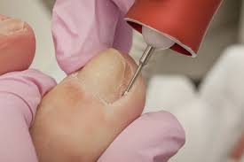 Image result for Akutní zánět nehtového lůžka