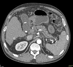 Pancreatic cancer is usually staged following a ct scan. Pancreatic Cancer With Local Spread Pancreas Case Studies Ctisus Ct Scanning