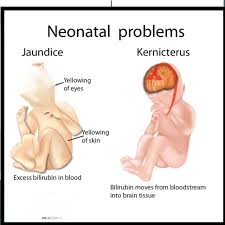 Image result for Kernicterus