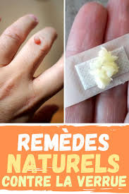 Remedes Naturels Contre La Verrue Verrue Remedes Naturels Remede