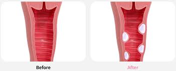 Image result for Atrophic Vaginitis