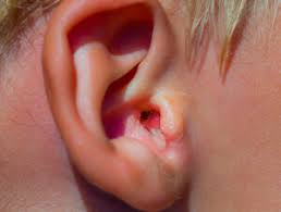 Image result for Acute Otitis Externa