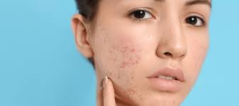 Image result for acne face