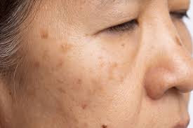 Image result for Melasma