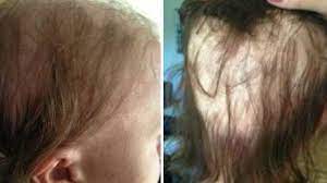 Si possono trovare decine e decine di capelli sul cuscino e sulle spalle, quantità considerevoli che . Alopecia In Gravidanza La Storia Di Una Donna