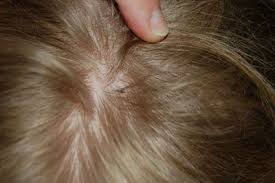 This video answers our most popular question. What Do Lice Look Like Pictures Of Nits Eggs And Lice