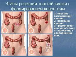 И как вообще с этим жить? Rak Pryamoj Kishki Lekciya Dlya Studentov V Kursa