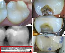 Wenn sie einen zahnarzt mit einem loch im zahn aufsuchen, diagnostiziert er in 90% der fälle eine karies. Selbsthilfen Im Notfall Empfehlungen Zur Zahnpflege Listerine Fluorid