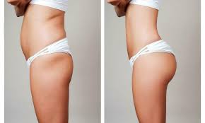 Le docteur jonathan fray, chirurgien esthétique à la réunion, pratique l'ensemble des interventions de chirurgie des fesses. Augmentation Fesses Par Protheses Duree De Vie Pour Les Implants Fesses