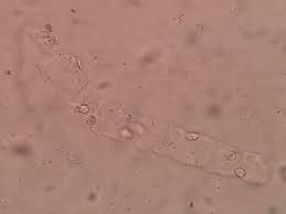 Image result for Urinary Cast