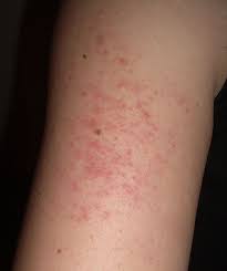 Do You Have Keratosis Pilaris Chicken Skin Try Efas Annmarie Gianni Skin Care Keratosis Pilaris Skin Bumps Treat Keratosis Pilaris