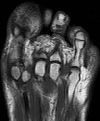 It is characterized by tenderness and burning pain in the plantar surface of the forefoot, with painful paresthesias in the. Morton Neuroma Radiology Case Radiopaedia Org