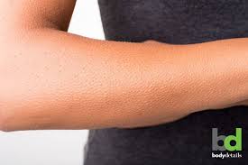 Avoid all alpha hydroxy and beta hydroxyl products (aha/bha), hydroquinone, retinols/retinoid, tazorac, and differin for 7 days before treatment. How Laser Hair Removal Can Treat Your Chicken Skin