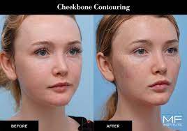 Goodbye Baby Face Hello Facial Fillers Botox Cosmetic In The Bay Area Mabrie Facial Institute Mabrie Facial Institute