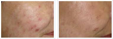 Acne scars before & after gallery. Acne Scar Laser Treatments Beverly Hills Laser Institute Inc