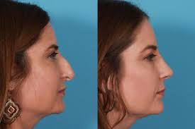 I've been searching high and low (read, through all the pattern mags i already own) for the perfect shirt dress pattern. Here Is The Solution For Your Perfect Nose Rhinoplasty In Dubai Rhinoplasty Dubai