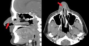 Image result for phlegmon on face)