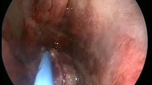 Nasal polyps (np) are benign swellings of the mucosal lining of the paranasal sinuses. Removal Of Huge Nasal Polyps Youtube