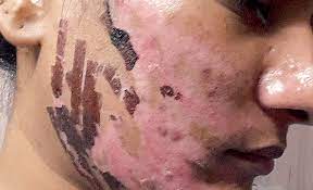 Though laser hair removal will delay hair follicles from regrowing hair, the procedure rarely will stop hair from ever growing again. Hyderabad Physiotherapist Carried Out Laser Hair Removal On Woman That Burnt Her Face