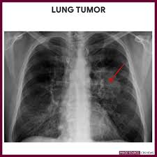 Chest X Ray Chest Radiography Nurse Study Guide Radiography Lunges Nursing Study Guide