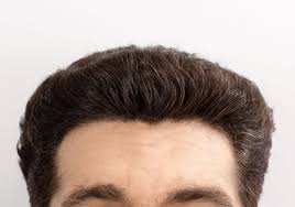 What You Want To Recognize About Hair Transplant Cost Hair Transplant Cost Hair Restoration Surgery Hair Transplant