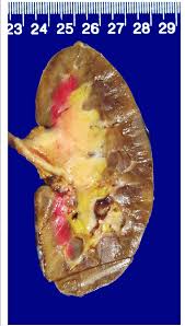 Renal causes of urine specific gravity changes. Gross Examination Revealed Thickened Mucosa Of The Renal Pelvis Download Scientific Diagram