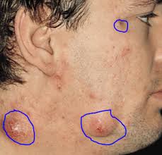 Learn how to pop an ingrown hair with no head. Pin On Www Healtreatcure Org