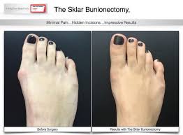 A Pre And Post Sklarbunionectomy Don T You Love For More Information On This Unique Bunion Procedure Visit Www Plastic Surgery Surgery Bunion Surgery