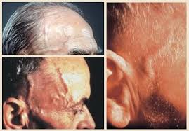 Image result for Jaw Claudication