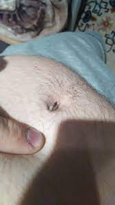 Was Ist In Meinem Bauchnabel Stinkt Und Ist Schwarz Weiss Soll Ich Ins Krankenhaus Gehen Arzt Hygiene Entzundung